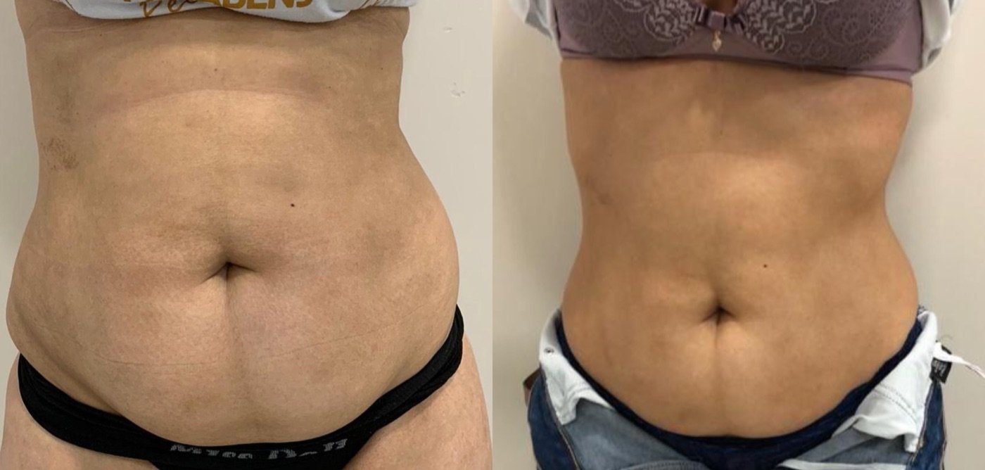 Abdômen de frente, antes e depois, com redução da gordura abaixo do umbigo