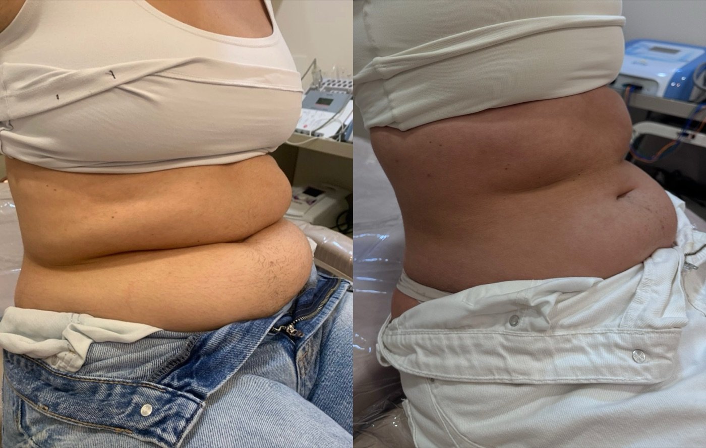 Costas e flancos, antes e depois