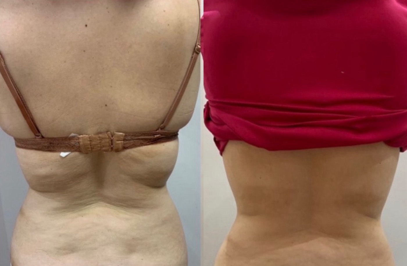 Costas, antes e depois