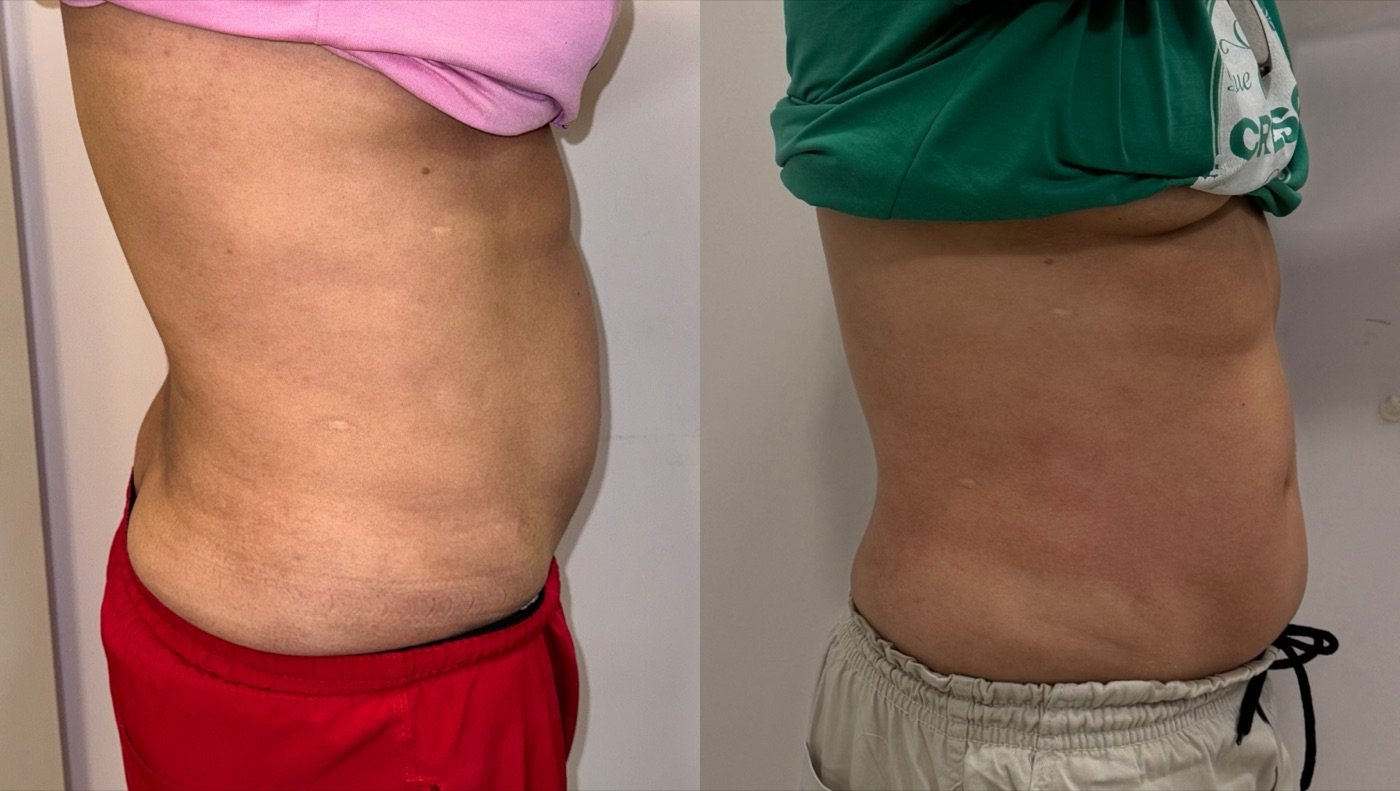Abdômen de perfil, antes e depois