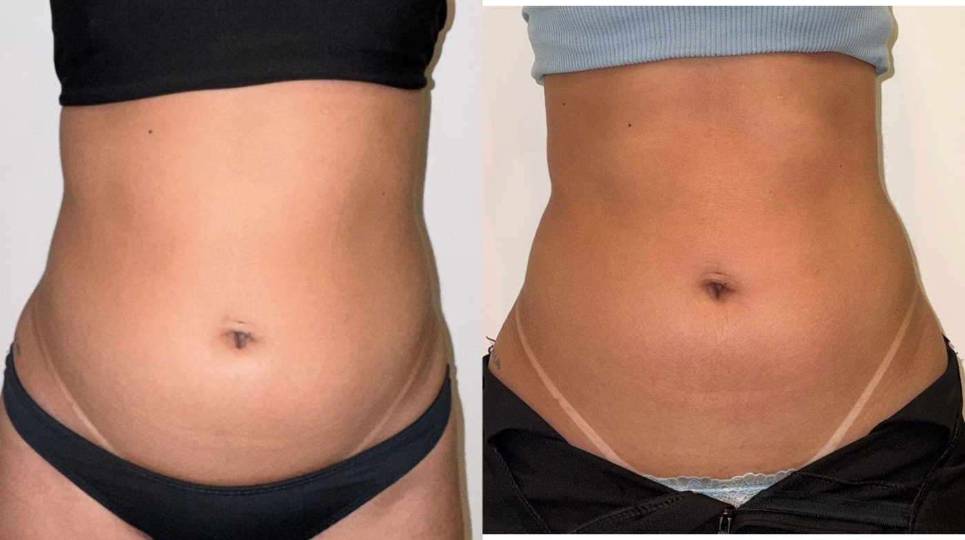 Abdômen e cintura, antes e depois