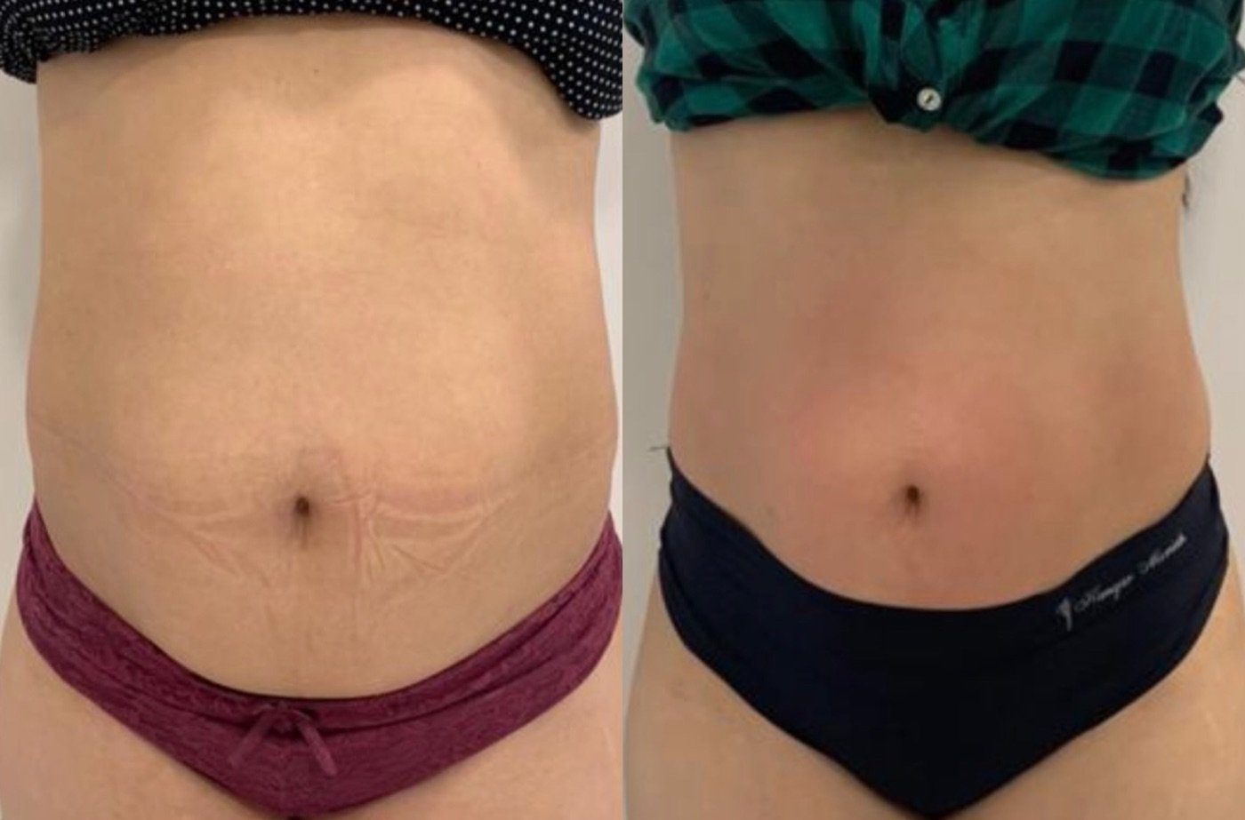 Abdômen de frente, antes e depois
