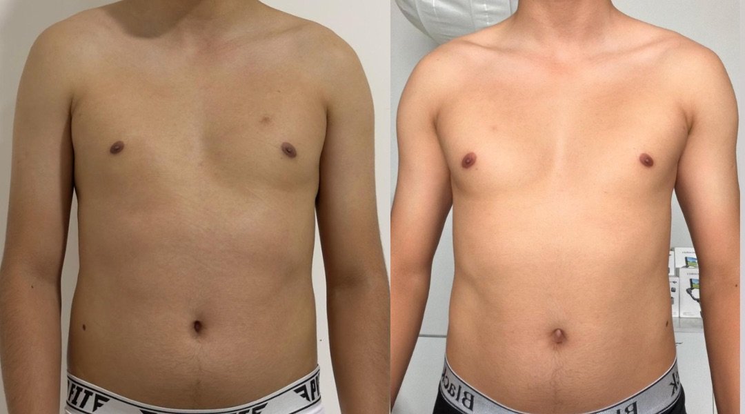 Peitoral e abdômen masculino, antes e depois
