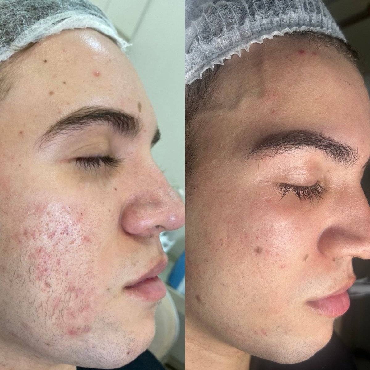 Rosto de perfil, antes e depois do tratamento para acne