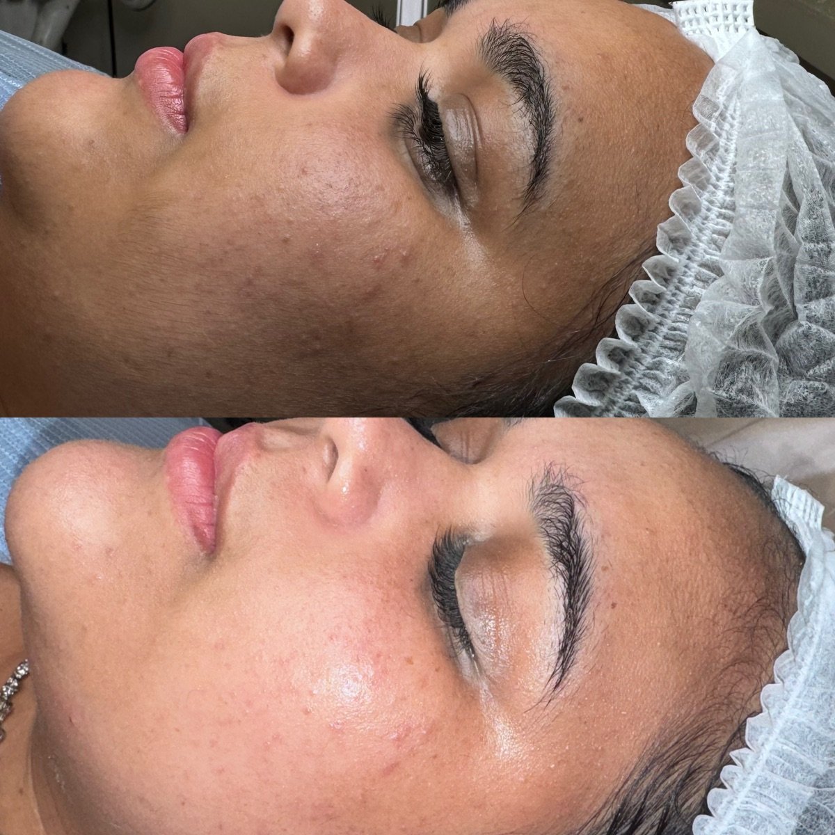 Pele do rosto, antes acima e depois abaixo