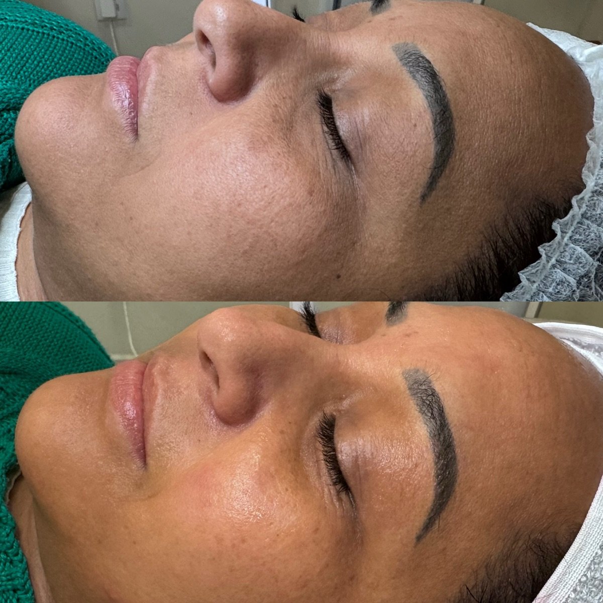 Pele do rosto, antes acima e depois abaixo