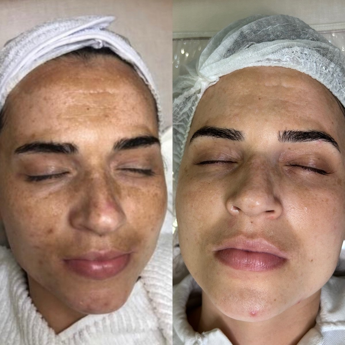 Rosto de frente, antes e depois