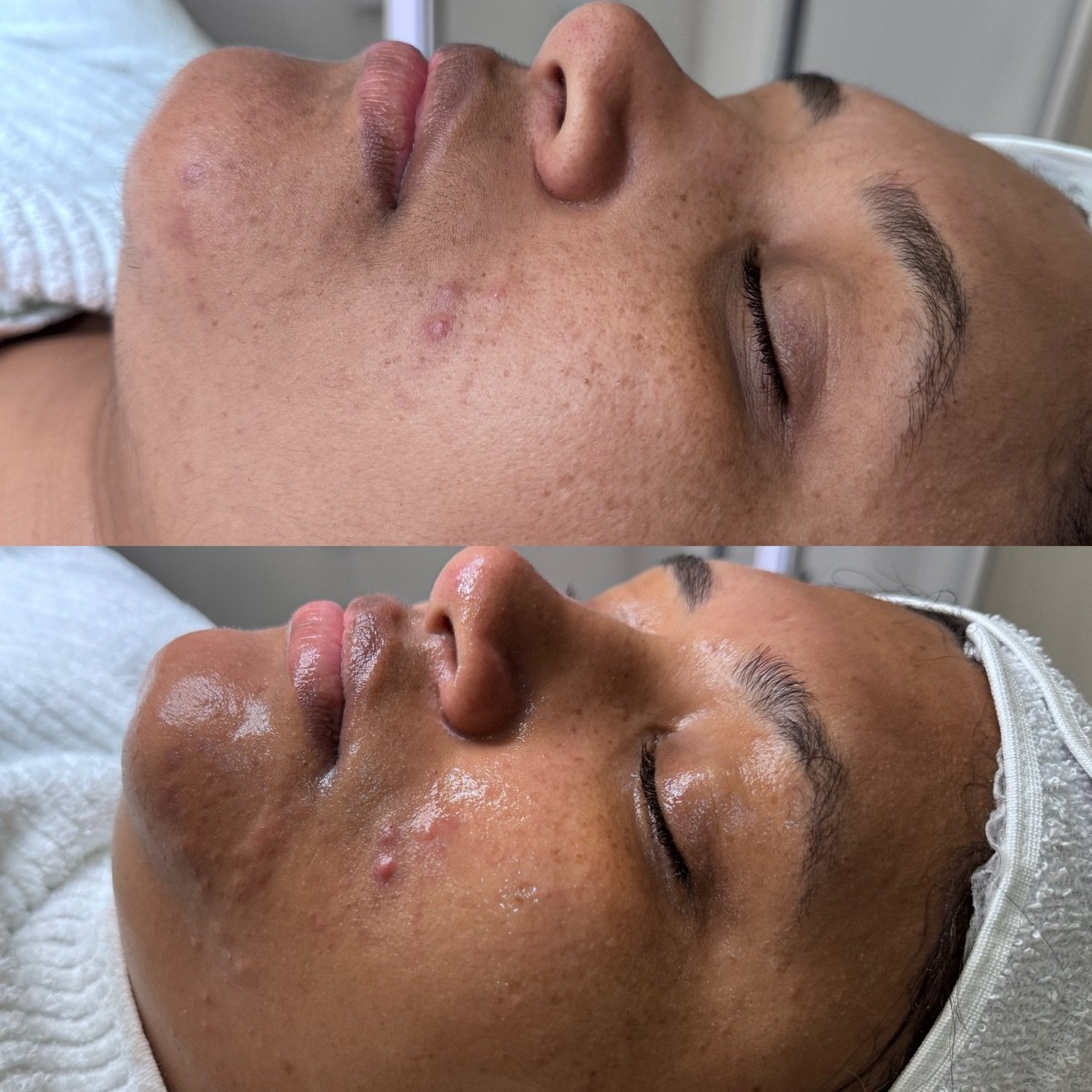 Pele do rosto, antes acima e depois abaixo