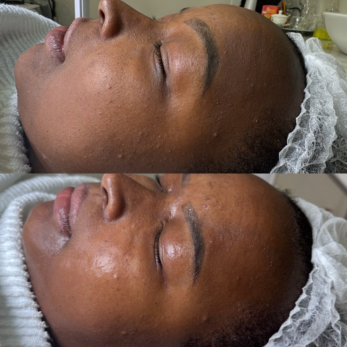 Pele do rosto, antes acima e depois abaixo